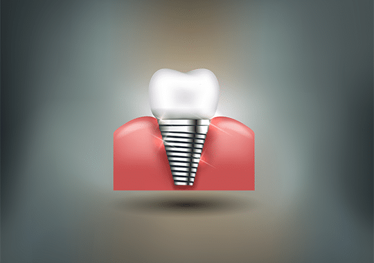 Dental Implants