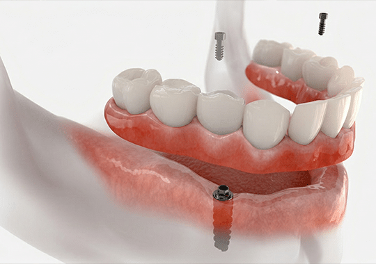 Pre-Prosthetic Surgery