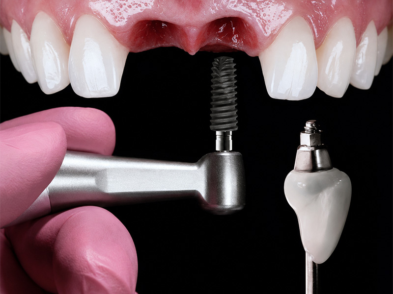 Bone grafting in Kansas City, KS at Midwest Oral Surgery
