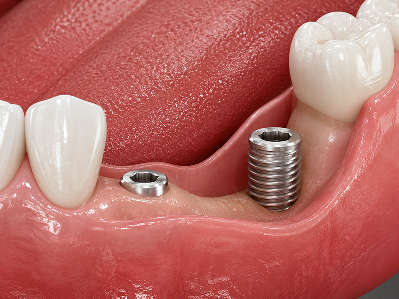 Dental bone graft material used to rebuild jawbone