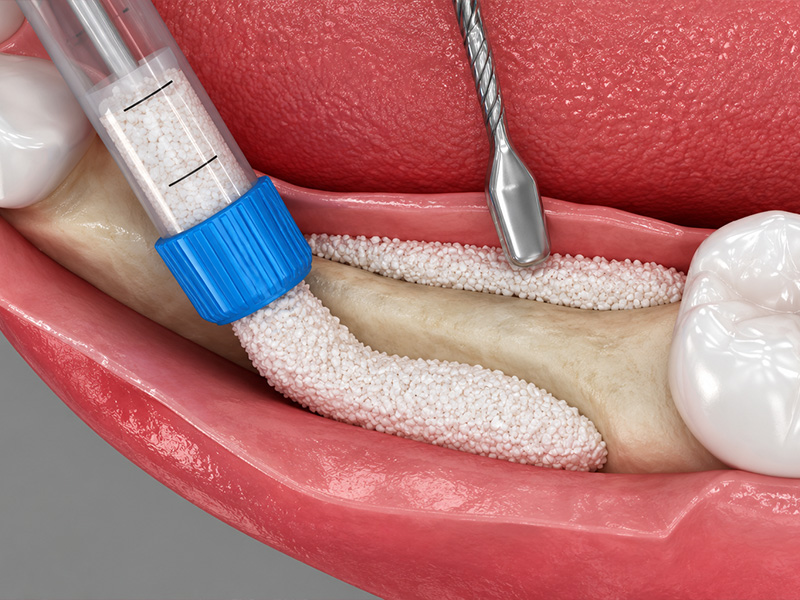 Patient consultation about missing teeth and bone loss in Kansas City, KS