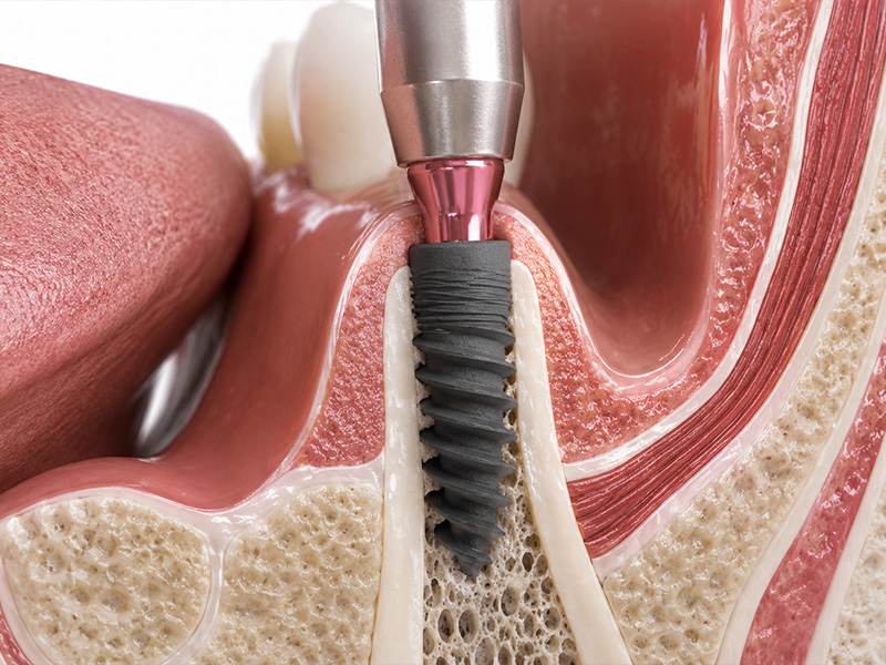 Oral surgeon performing a bone grafting procedure with IV sedation available