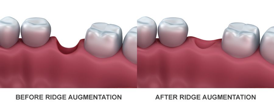 ridge augmentation Leawood KS